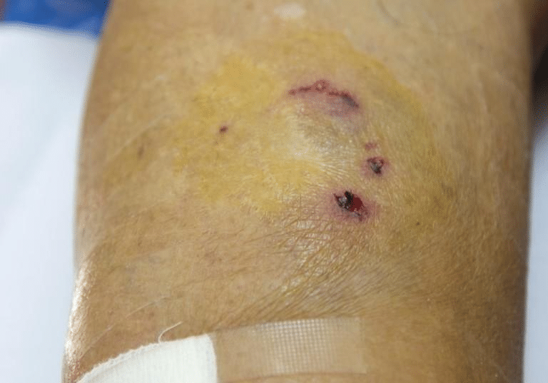 An infected dog bite that's bruising on an individuals arm.