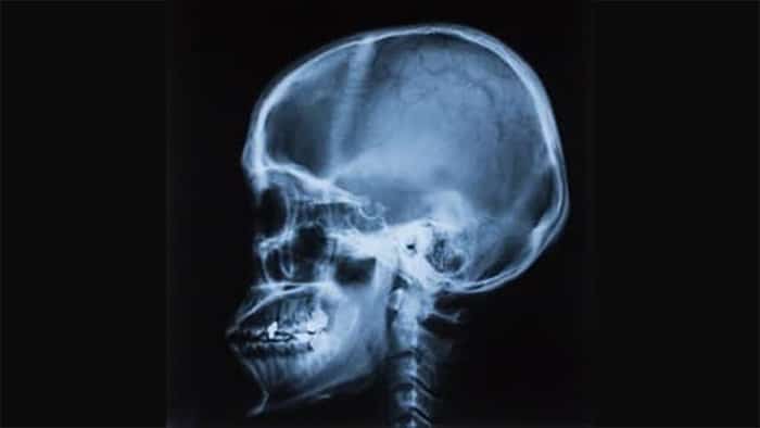 An x-ray of a human head.