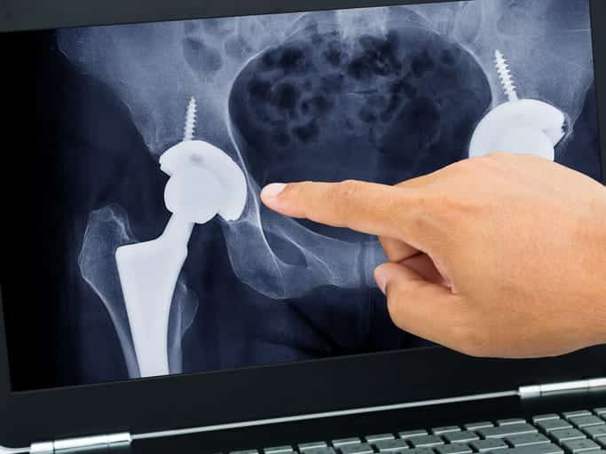 A doctor showing a screw from a hip replacement surgery in a patient's x-ray.