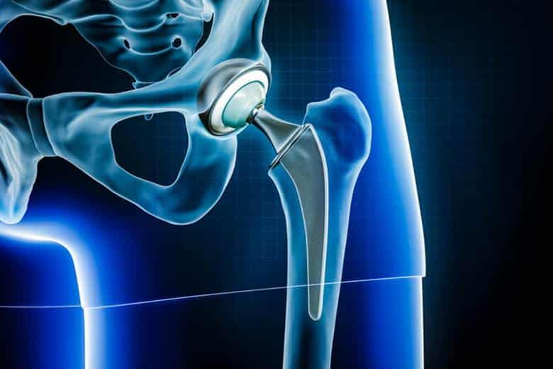 A graphic showing a hip replacement.