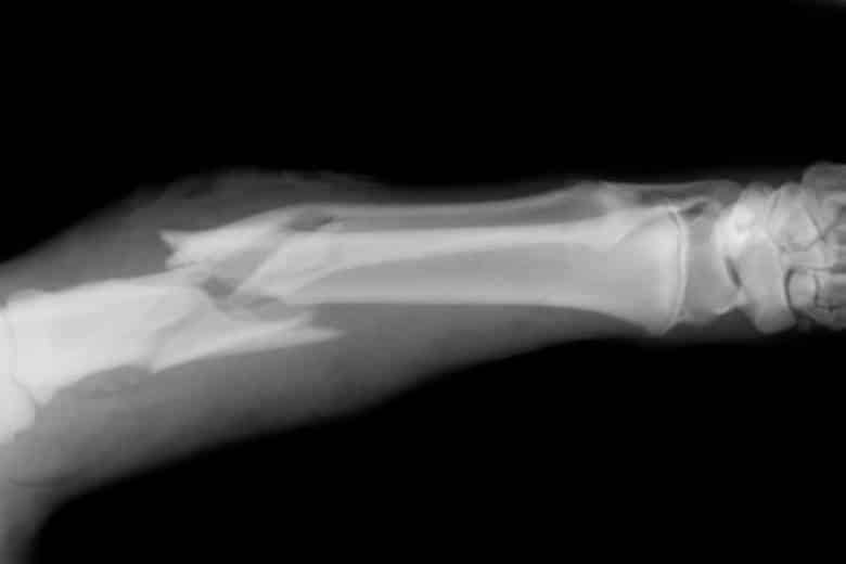 An x-ray showing a broken bone.